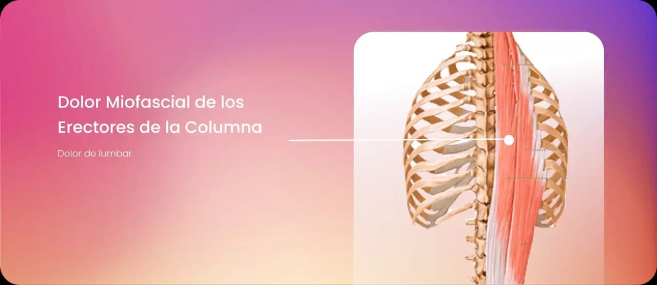 Músculos erector de la columna: su importancia para la salud lumbar Músculos erector de la columna: su importancia para la salud lumbar